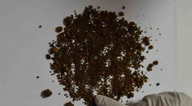 Safra kesesinden 4 bin 536 taş çıktı