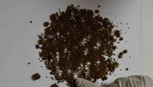 Safra kesesinden 4 bin 536 taş çıktı