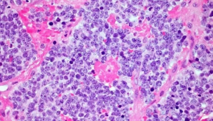 Kanseri tedavisinde çığır açan keşif: CART-T hücreleri görülmemiş başarı sağladı